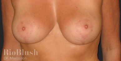 Scar marks after